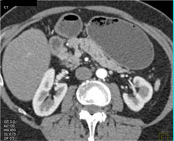 Focal Fat in Pancreas - CTisus CT Scan