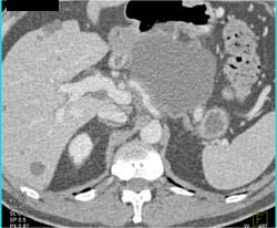 Cystadenoma - CTisus CT Scan