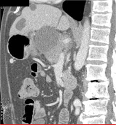 Cystadenoma - CTisus CT Scan