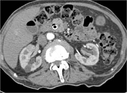 Pancreatic Cancer With Wall Stent and Stenosis of SMA - CTisus CT Scan