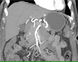 Tumor Arises Off Uncinate Process - CTisus CT Scan