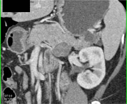 Ca Body of Pancreas and Intraductal Papillary Mucinous Neoplasm (IPMN) in Tail of Pancreas - CTisus CT Scan