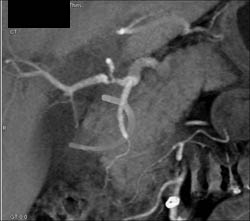 Hepatic Artery Stenosis Following Liver Transplant - CTisus CT Scan