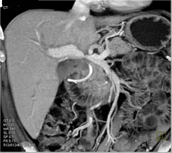 Portal Vein Narrowing at Anastomosis Following Liver Transplant - CTisus CT Scan