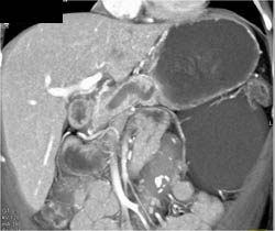 Dilated Pancreatic Duct Due to 4mm Islet Cell Tumor - Vascular - CTisus CT Scan