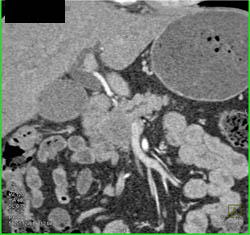 Pancreatic Cancer Encases the PV/SMV - CTisus CT Scan