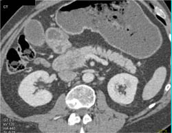 Pancreatic Cancer Encases the PV/SMV - CTisus CT Scan