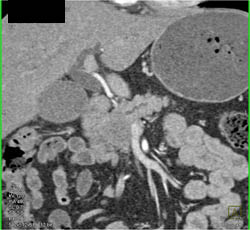 Pancreatic Cancer Encases the PV/SMV - CTisus CT Scan