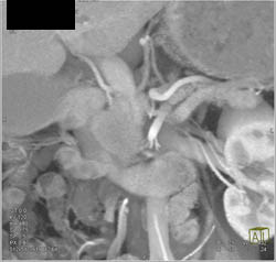 Pancreatic Cancer Encases the PV/SMV - CTisus CT Scan