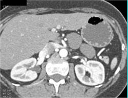 Lymphangioma - CTisus CT Scan