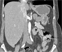 Lymphangioma - CTisus CT Scan