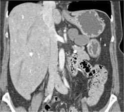 Lymphangioma - CTisus CT Scan