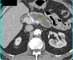 Dilated Pancreatic Duct With Gland Atrophy Due to Proximal Tumor - CTisus CT Scan