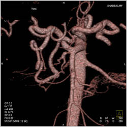 Narrow Celiac Artery With Collaterals Through the Gastroduodenal Artery (GDA) - CTisus CT Scan