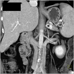 Duplicated IVC Beneath Renal Veins - CTisus CT Scan