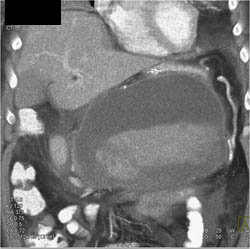 Hemorrhagic Pancreatitis - CTisus CT Scan