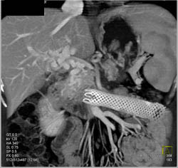 Invasive Pancreatic Cancer With Stent Near Ligament of Treitz - CTisus CT Scan