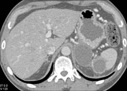 Pseudocyst Compresses Splenic Vein - CTisus CT Scan