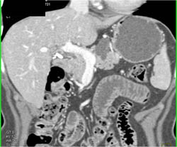 Intraductal Papillary Mucinous Neoplasm (IPMN) - CTisus CT Scan