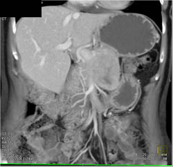 Islet Cell Tumor - CTisus CT Scan