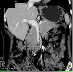 Islet Cell Tumor - CTisus CT Scan