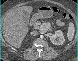 Islet Cell Tumor - CTisus CT Scan