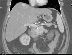 Islet Cell Tumor - CTisus CT Scan