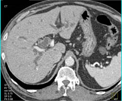 Dilated Common Bile Duct (CBD) and Intrahepatic Duct Due to Pancreatic Cancer - CTisus CT Scan