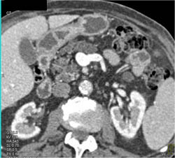 Multiple Intraductal Papillary Mucinous Neoplasms (IPMNs) - CTisus CT Scan