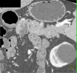 Intraductal Papillary Mucinous Neoplasm (IPMN) - CTisus CT Scan