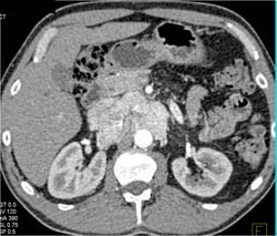 Atrophy of the Distal Body and Tail of the Pancreas - CTisus CT Scan