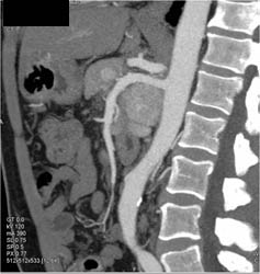 Islet Cell Tumor Growing Posteriorly - CTisus CT Scan