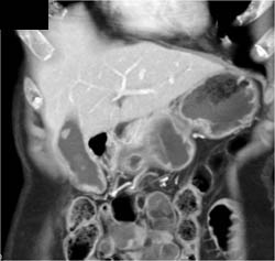 Stones in Thick Walled Gallbladder - CTisus CT Scan