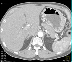 Subtle Carcinoma in the Body of the Pancreas - CTisus CT Scan