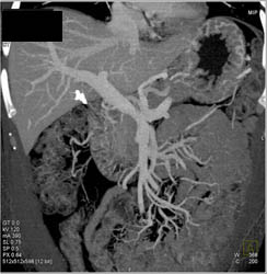 Subtle Carcinoma in the Body of the Pancreas With Portal Vein Narrowing - CTisus CT Scan