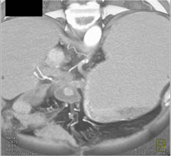 Post Whipple With Nodule - CTisus CT Scan