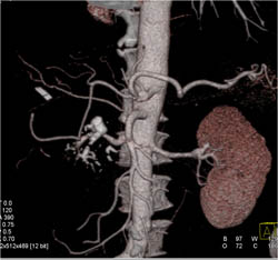 Chronic Pancreatitis - CTisus CT Scan