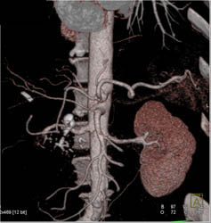 Chronic Pancreatitis - CTisus CT Scan