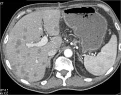 Liver Metastases S/P Whipple. See Prior Visualization With MIP and Shaded Surface Images - CTisus CT Scan