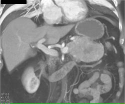 Islet Cell Tumor - CTisus CT Scan