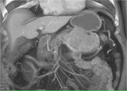 Islet Cell Tumor - CTisus CT Scan