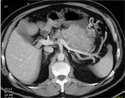 Islet Cell Tumor - CTisus CT Scan