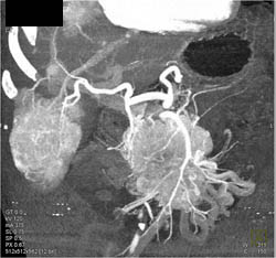 Islet Cell Tumor With Liver Metastases and Vessel Encasement - CTisus CT Scan