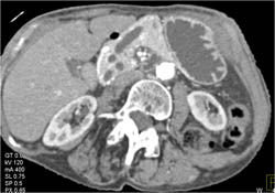 Dilated Pancreatic Duct With Pancreatic Mass - CTisus CT Scan