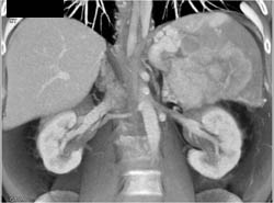 Islet Cell Tumor - CTisus CT Scan