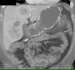 Islet Cell Tumor - CTisus CT Scan