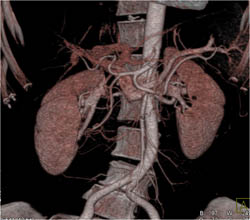 Islet Cell Tumor - CTisus CT Scan