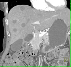 Liver Metastases From Pancreatic Cancer - CTisus CT Scan