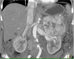 Islet Cell Tumor - CTisus CT Scan