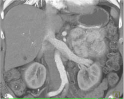 Islet Cell Tumor - CTisus CT Scan